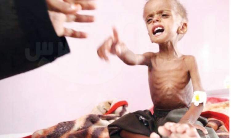 الأمم المتحدة : إغلاق 26 برنامجا في اليمن ومليونا طفل بحاجة للعلاج من سوء التغذية