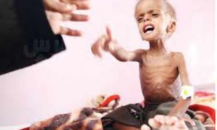أطفال اليمن يدفعون ثمن العدوان