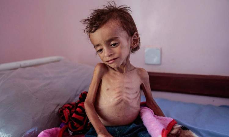 الأمم المتحدة : 5 ملايين يمني على بعد خطوة من المجاعة