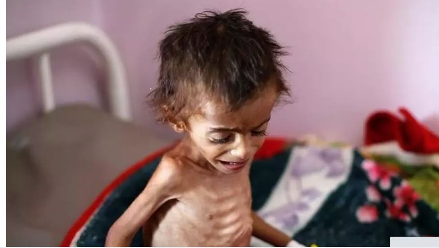 45% من سكان اليمن يعانون من انعدام الأمن الغذائي