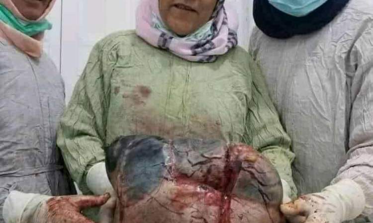 صنعاء:  استئصال ورم بحجم كيس سكر من امرأة عجوز (صورة)
