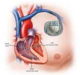 تطوير جهاز تنظيم ضربات القلب خال من البطاريات!