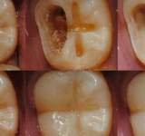 3 أسباب وراء تسوس الأسنان رغم تنظيفها يوميا