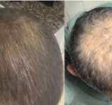دواء جديد لاستعادة الشعر بالكامل لمن يعاني الصلع