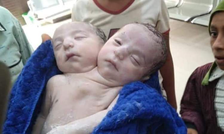 ولادة طفل سيامي برأسين في محافظة الحديدة( صورة)