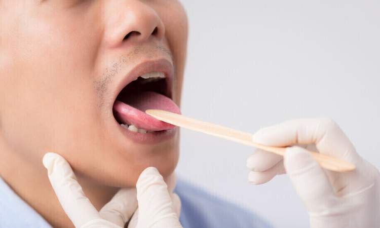 6 أعراض لسرطان الفم يجب أن يعرفها الجميع