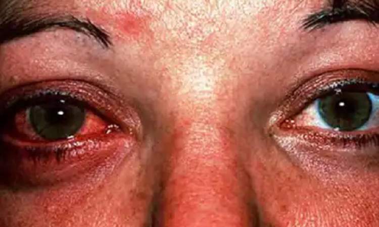 تفشي مرض العين الوردية في عدد من دول اسيا وافريقيا ورواندا تصدر تحذيرا 