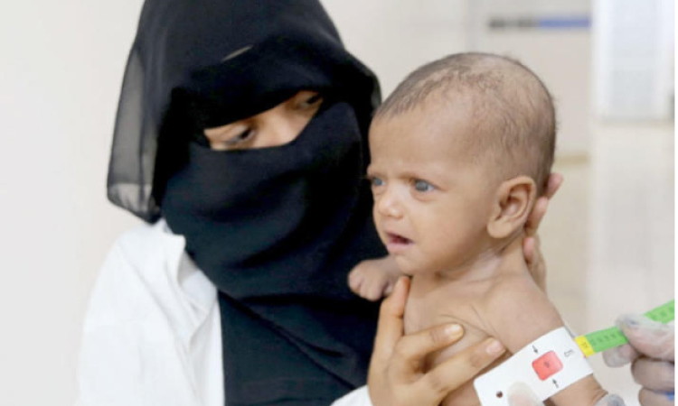 أوتشا:17 مليون يمني بحاجة للمساعدات
