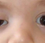 “العين الكسولة: إشارة إلى مشكلات صحية أكثر خطورة 